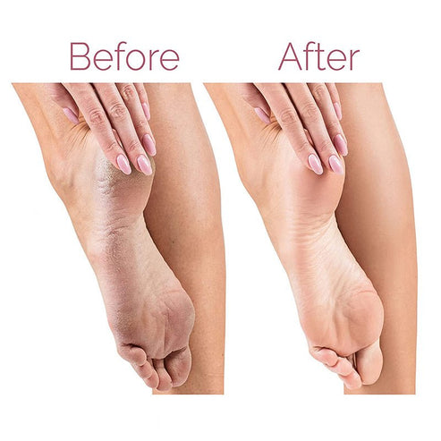 PEDICURE FOOT CALLUS REMOVER