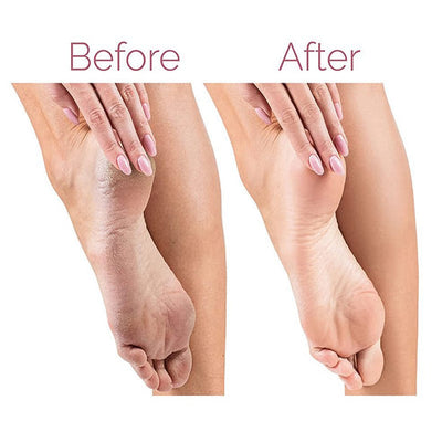 PEDICURE FOOT CALLUS REMOVER